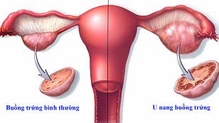 U nang buồng trứng nào nguy hiểm và khó điều trị nhất